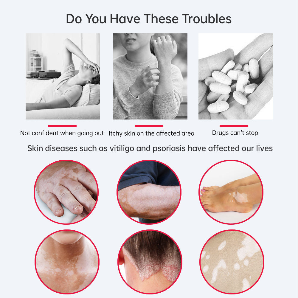 Best UVB Phototherapy Lamp for Home Skin Care: A Professional Light Therapy Solution