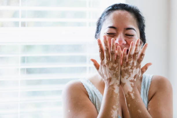 What we need to know when we get vitiligo on hands?