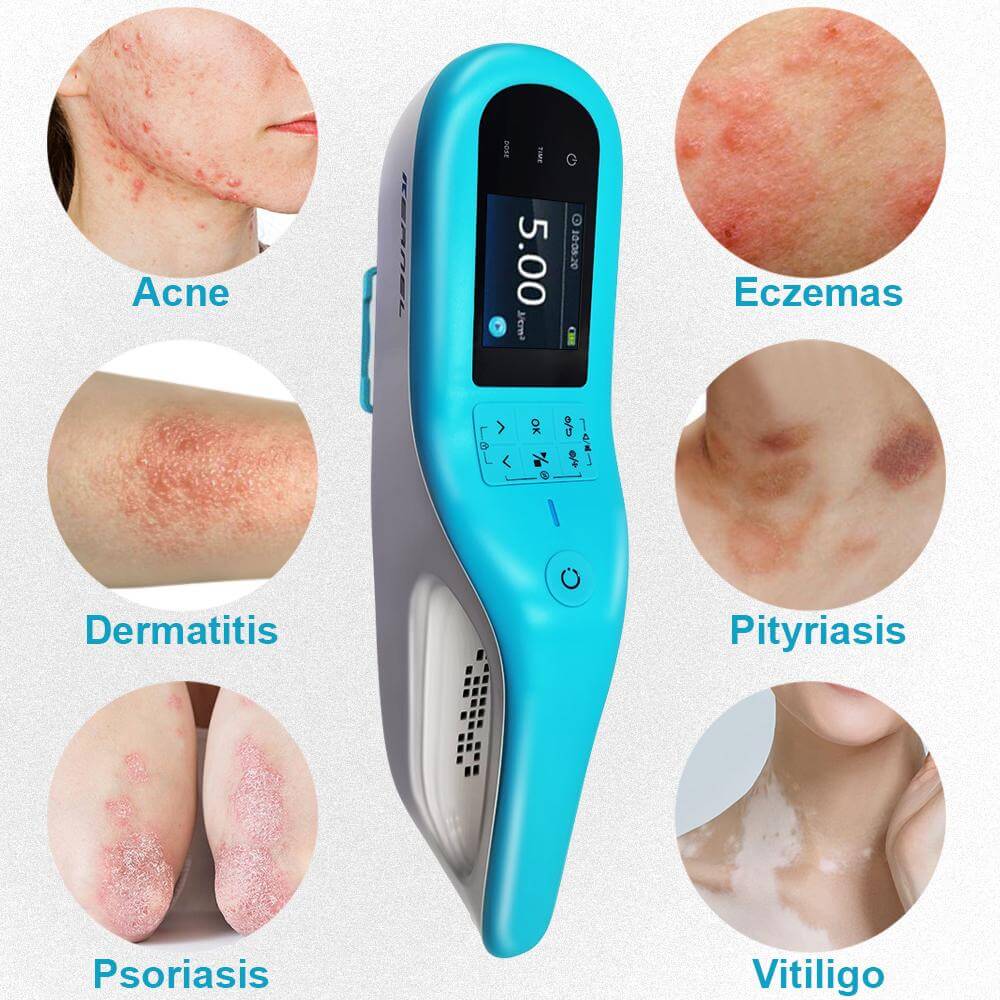 Kernel 308-nm Excimer Laser For Psoriasis Ultraviolet Light Therapy
